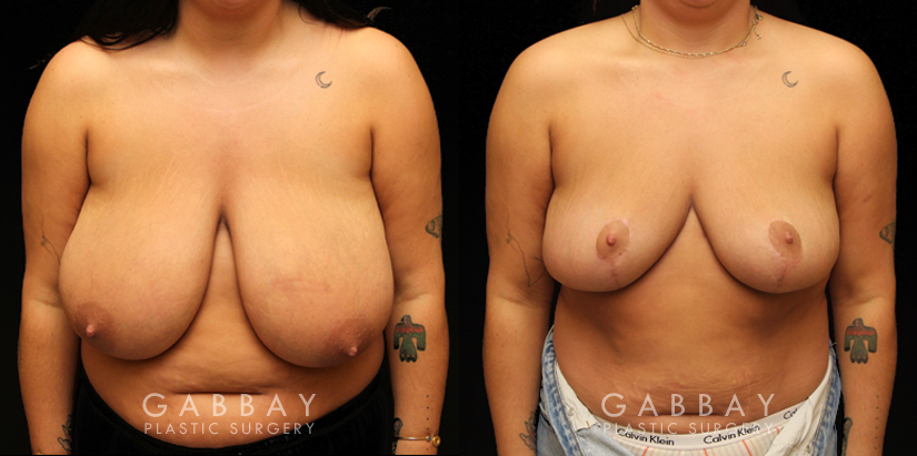 Procedures Depicted:  Breast reduction with lift