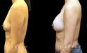 Breast augmentation results for patient in her 40s. Volume increase is mild but retains a natural shape to the breasts with retained symmetry.