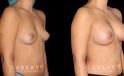 Silicone implants used to increase breast size in female patient in her 30s. Boost ot breast volume resulted in a more feminine contour from each before-and-after photo angle.