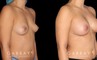 Silicone implants used to increase breast size in female patient in her 30s. Boost ot breast volume resulted in a more feminine contour from each before-and-after photo angle.