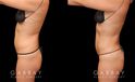 Female patient in her 30s wanted to reduce mild stomach fat bulging from stubborn pockets of fat. Liposuction removed the fat and restored a smoother belly contour visible from multiple sides.