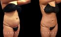 Abdominoplasty before and after photos post-recovery. Patient’s healing went smoothly, resulting in a firmer, tighter abdominal region, with a refined contour particularly visible in side profile.