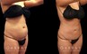 Abdominoplasty before and after photos post-recovery. Patient’s healing went smoothly, resulting in a firmer, tighter abdominal region, with a refined contour particularly visible in side profile.