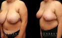Patient 05 3/4th Left Side View Breast Reduction Gabbay Plastic Surgery