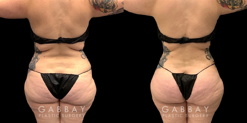 Procedures Depicted:  Abdomen Lipo Female liposuction results for a flatter abdomen. Note how fat reduction was done with her natural figure in mind for results that match her unique features.