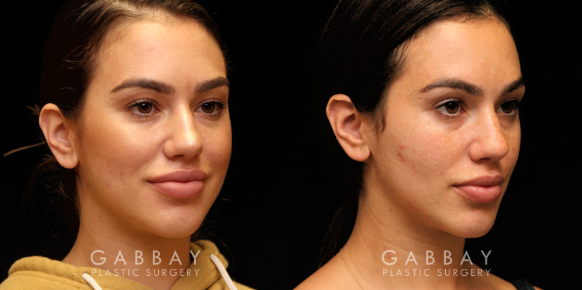 Procedures Depicted:  Buccal Fat Pad Removal