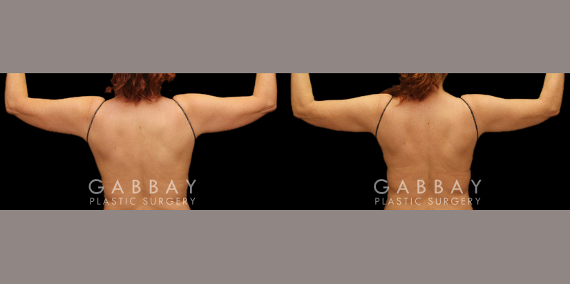 Procedures Depicted:  Lipo & J Plasma of bilateral arms, bbr, waist,abdomen