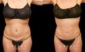 Before and after photos for a mini tummy tuck patient, with combined liposuction around the waist. The combined procedure resulted in notable flattening of the stomach with all fat rolls smoothed out.