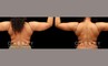 Procedures Depicted:  Arm lipo