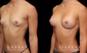 Patient before and after breast augmentation with silicone implants for both breasts. Patient’s naturally slender body type balanced well with smaller implants.