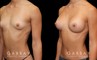 Patient before and after breast augmentation with silicone implants for both breasts. Patient’s naturally slender body type balanced well with smaller implants.