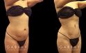 Female patient before and after belly liposuction, enhancing her figure while providing a flatter stomach visible from the side and front. Note the lack of visible scarring.