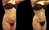 Female patient before and after belly liposuction, enhancing her figure while providing a flatter stomach visible from the side and front. Note the lack of visible scarring.