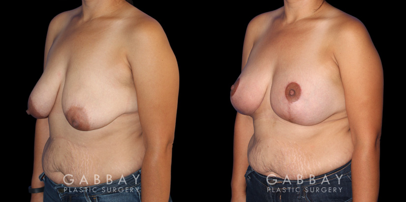 Procedures Depicted:  Breast Augmentation – Silicone, Mastopexy