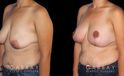 Procedures Depicted:  Breast Augmentation – Silicone, Mastopexy