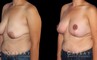 Procedures Depicted:  Breast Augmentation – Silicone, Mastopexy