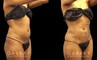 Female patient with notable contouring of the abdominal area after liposuction, resulting in a more youthful figure free from any bulging fat deposits.