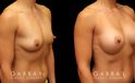 Patient photos showing before and after her breast augmentation procedure, with notable breast size increase while maintaining a balanced aesthetic.