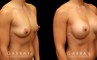 Patient photos showing before and after her breast augmentation procedure, with notable breast size increase while maintaining a balanced aesthetic.