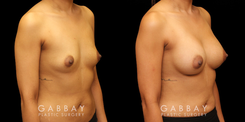 Before and after silicone implants for female patient. Her breast augmentation went smoothly and the recovery was without complications.