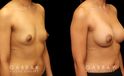 Before and after silicone implants for female patient. Her breast augmentation went smoothly and the recovery was without complications.