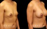 Before and after silicone implants for female patient. Her breast augmentation went smoothly and the recovery was without complications.