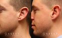 Patient 03 Left Side View Earlobe Repair Gabbay Plastic Surgery