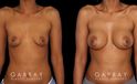 Silicone implants were used to increase breast volume while preserving the patient’s natural breast shape. The increased bust size resulted in a feminine, refined profile.