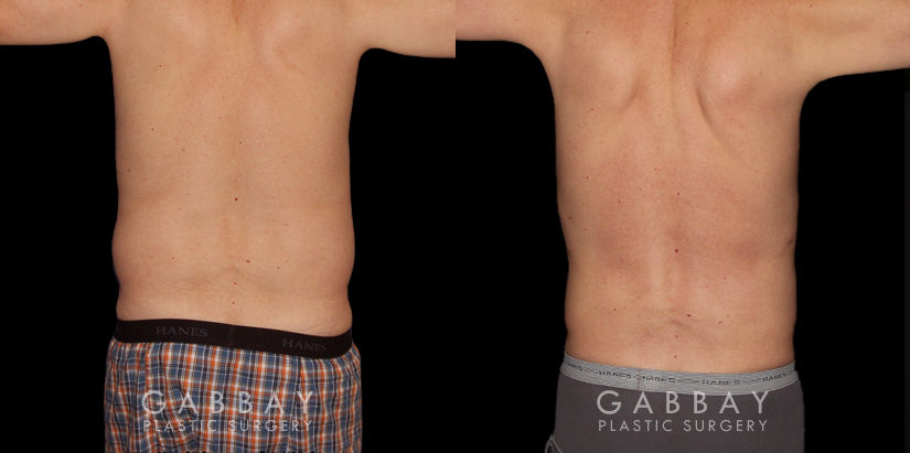 Patient 16 Back View Waist Lipo Gabbay Plastic Surgery