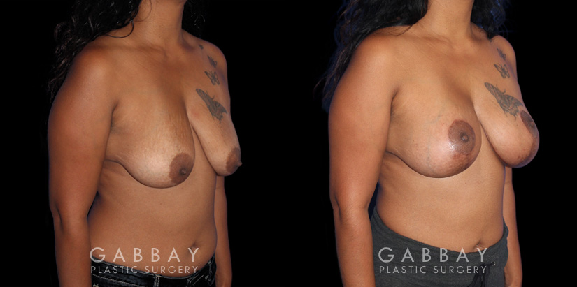 Procedures Depicted:  Wise Mastopexy with Silicone Breast Implants