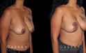 Procedures Depicted:  Wise Mastopexy with Silicone Breast Implants