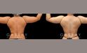Patient 21 Back View Lipo Arms Gabbay Plastic Surgery