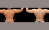 Patient 21 Back View Lipo Arms Gabbay Plastic Surgery