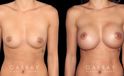 Breast augmentation patient with final results Note the significant increase in breast volume while keeping the shape within natural bounds. Note the absence of visible scarring which is rare with such increases in breast volume.