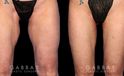 Patient 01 Front View Thigh Lift Gabbay Plastic Surgery