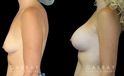 Patient in her mid 40s following breast augmentation. Before-and-after photos show her fully healed results from each angle, demonstrating the improved breast volume.