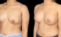 Silicone breast augmentation results, with patient having notable increase in breast volume and protrusion. But the breasts still maintain a balance between them.