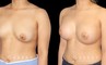 Silicone breast augmentation results, with patient having notable increase in breast volume and protrusion. But the breasts still maintain a balance between them.