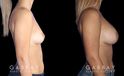 Visual of results following recovery for breast augmentation with saline implants. Patient shows dramatic increase in breast volume while keeping a more natural slope and shape to the breasts.
