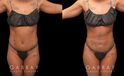 Multiple views of African-American female patient before and after combined liposuction and 360 lipo. Patient’s waist has notable slimming and contouring that enhances the fullness of the buttock. With the butt lift injections, the top position of the butt appears higher, resulting in a rounder curve with a more pronounced gluteal shape.