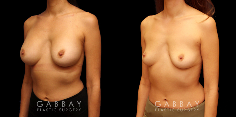 Procedures Depicted:  Implant Removal