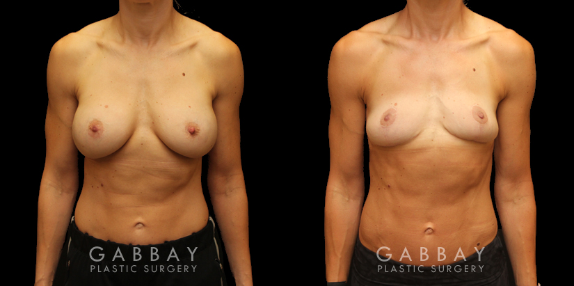 Procedures Depicted:  Implant removal/Mastopexy/Auto Augmentation