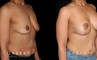 Patient with combined breast lift and breast augmentation using saline implants. Patient fully recovered from the combination procedure with excellent results.