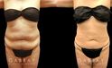 Mid 40s female patient after abdominal liposuction results have full healed, showing a tightened lower torso with belly rolls smoothed out for a flatter overall contour.