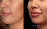 Patient 12 3/4th Left Side View Buccal Fat Pad Removal Gabbay Plastic Surgery