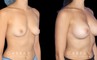 Breast augmentation before-and-after photos for female patient. Final results healed well, matching her body shape and contour well.