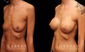 Patient wanted dramatic increase in breast volume using silicone implants. Breast position was not changed, with the main focus being boost to size and roundness of the breasts.
