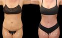 Patient photos of results from tummy tuck procedure at Gabbay Plastic Surgery. Patient recovered well, and results show a firmer, tighter abdominal area with notable improvements in silhouette and side angle views.