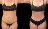 Patient photos of results from tummy tuck procedure at Gabbay Plastic Surgery. Patient recovered well, and results show a firmer, tighter abdominal area with notable improvements in silhouette and side angle views.