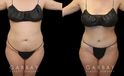 Mild tummy tuck results photos showing the patient’s smoother abdomen, absence of visible scarring, and natural appearance to results. Rather than look like a surgery, the slimming effect blends with her natural features.